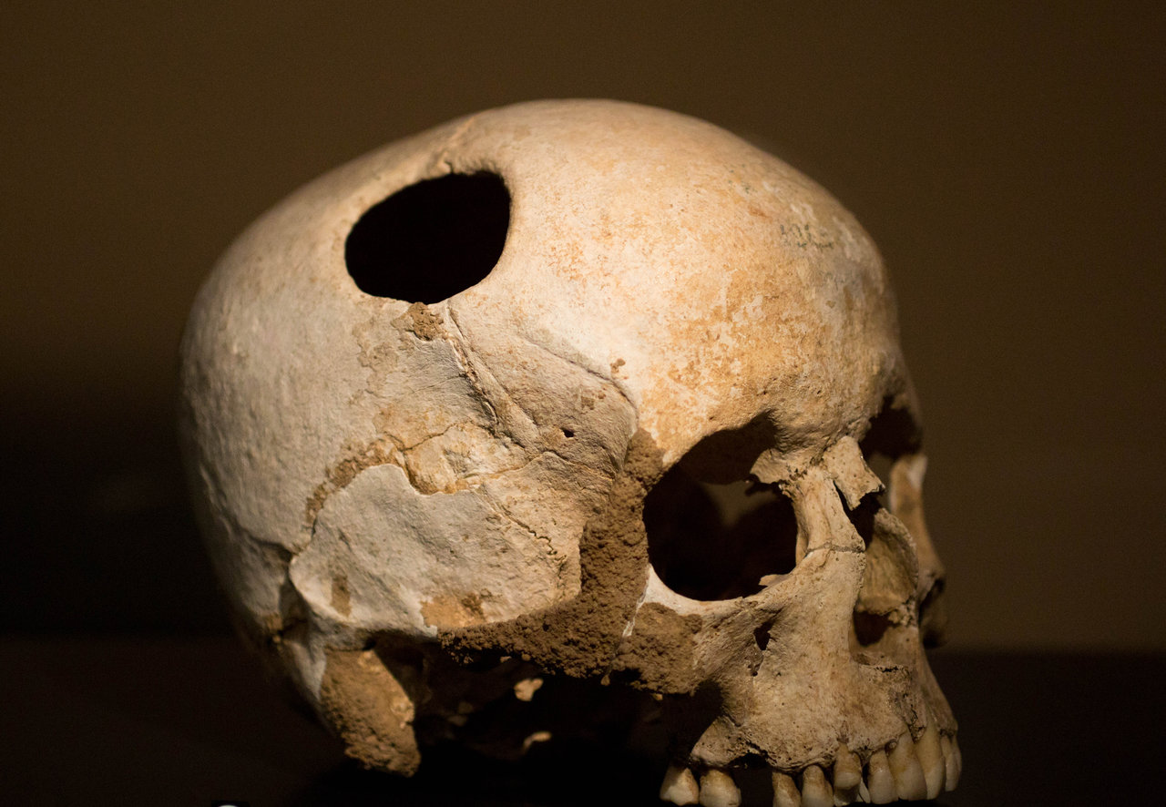 Самый древний череп человека. Трепанация черепа древние люди. Трепанация черепа в древние века. Древнейшая Трепанация черепа. Древние черепа после трепанации.